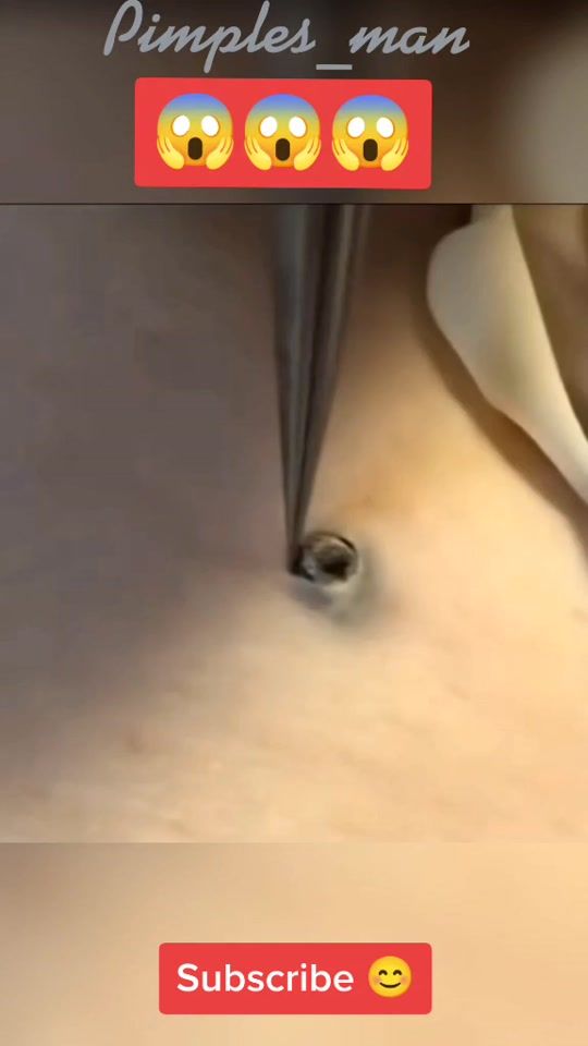 TikTok video thumbnail by pimples_man