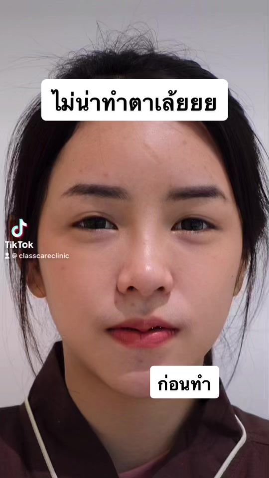 TikTok video thumbnail by classcare_clinic