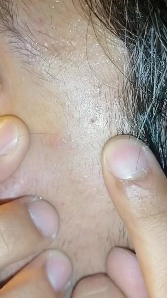 TikTok video thumbnail by sticky_pimples
