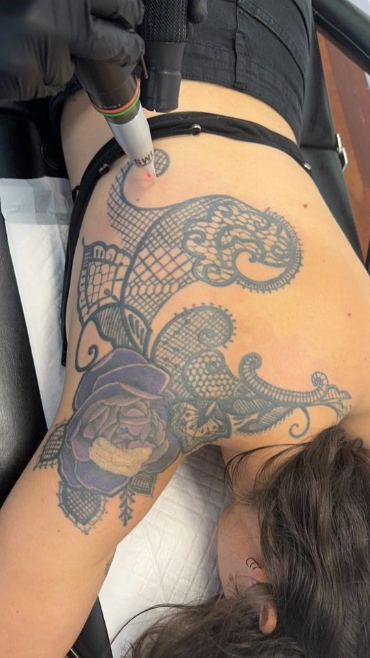 TikTok video thumbnail by swlasertattooremoval