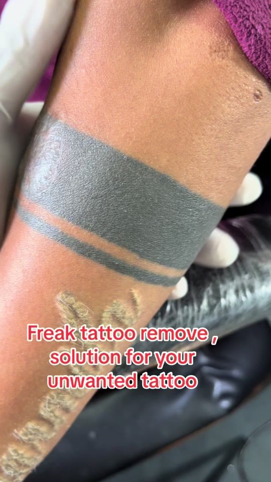 TikTok video thumbnail by freaktattooremove