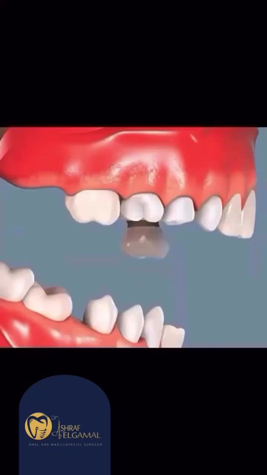 TikTok video thumbnail by dr.ashrafelgamal