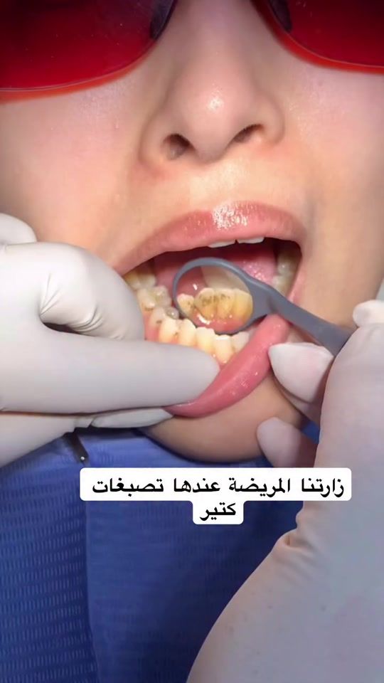 TikTok video thumbnail by dr_alaaayman