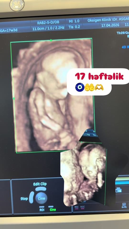 TikTok video thumbnail by ginekoloqnaride