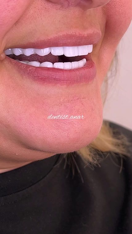 TikTok video thumbnail by dentist.anar