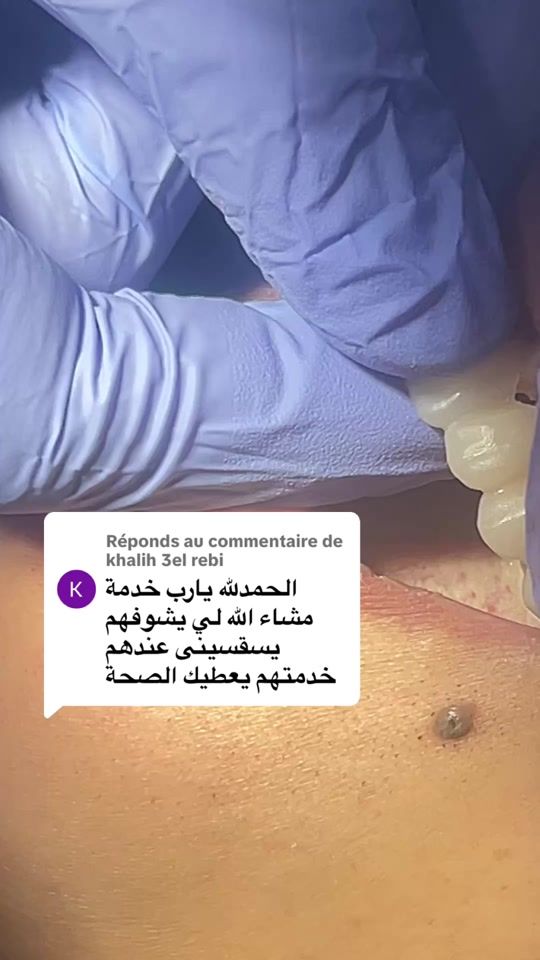 TikTok video thumbnail by dr.elbouali.02chlef