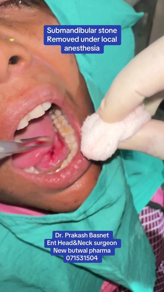 TikTok video thumbnail by dr.prakashbasnet