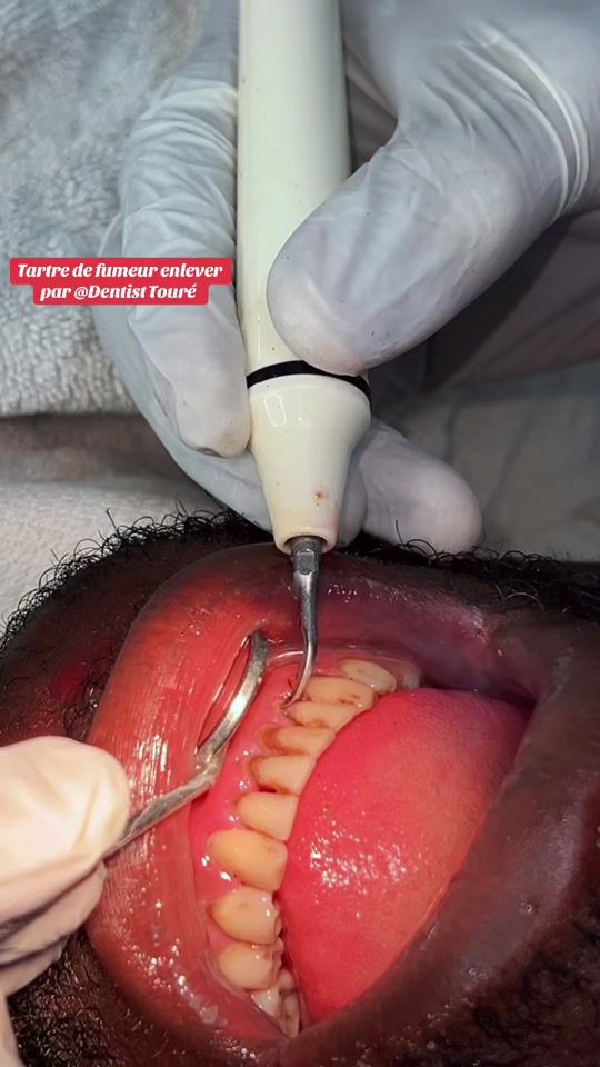 TikTok video thumbnail by ft_medecin_bouare