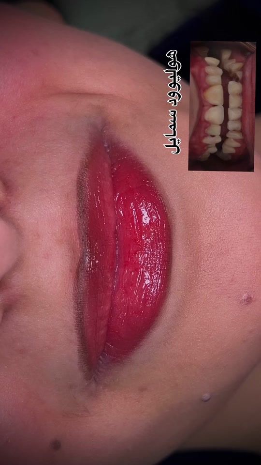 TikTok video thumbnail by dr.mohamed.bandi