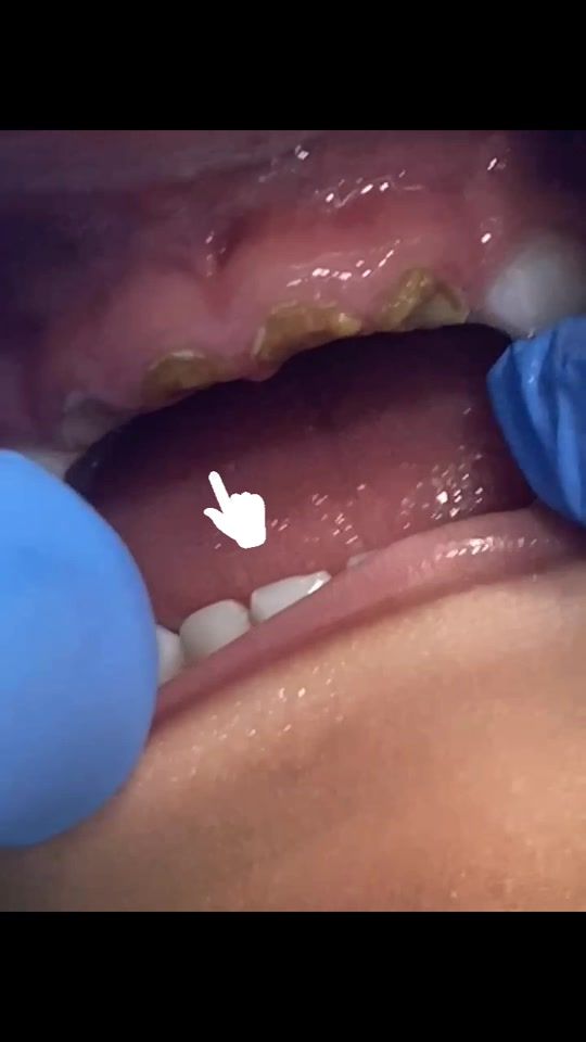 TikTok video thumbnail by escudental