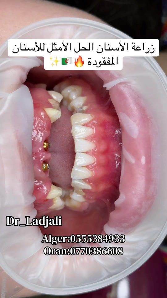 TikTok video thumbnail by dr.ladjali