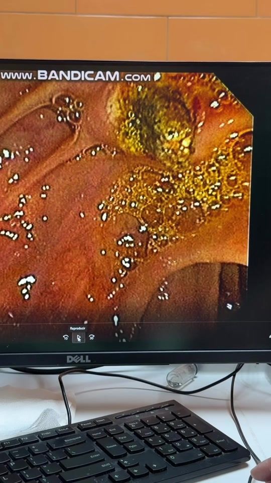 TikTok video thumbnail by dr.cesartrochez