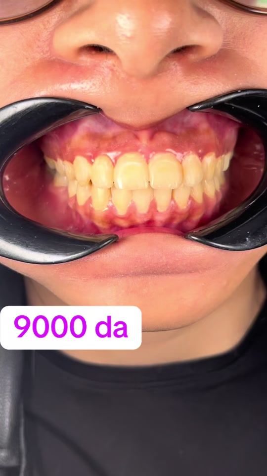 TikTok video thumbnail by drmarwa230