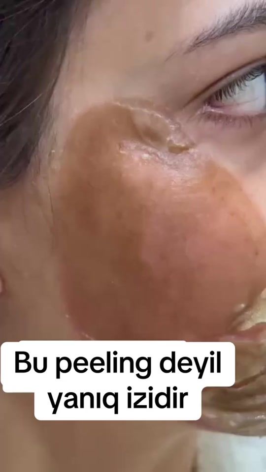 TikTok video thumbnail by dermatoloq_feride