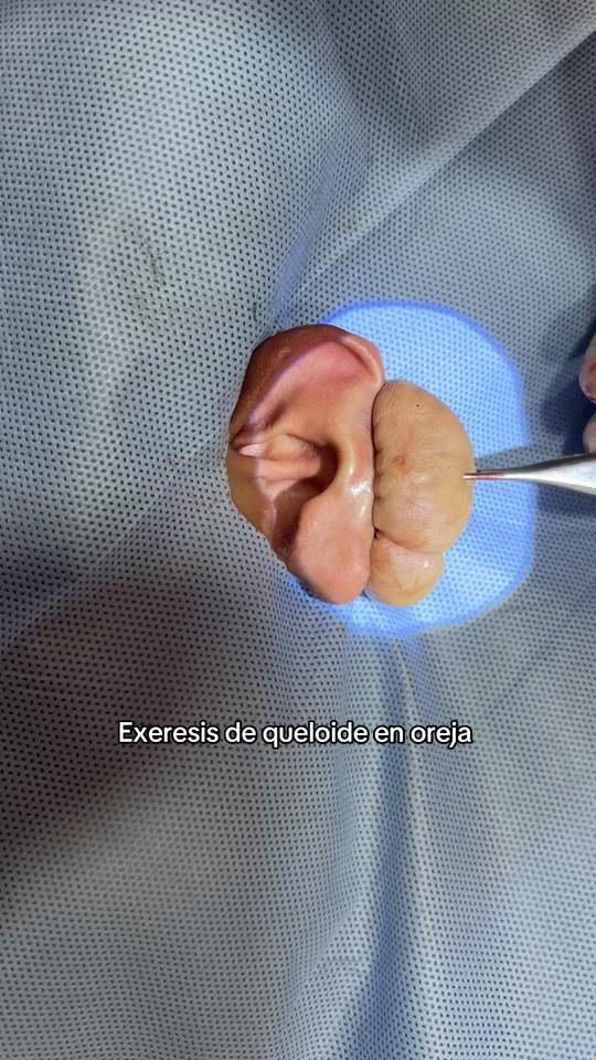TikTok video thumbnail by dr.loaiza
