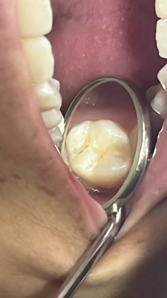 TikTok video thumbnail by odonto_ate
