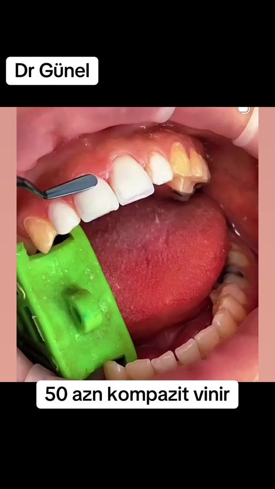 TikTok video thumbnail by dentist_gunel