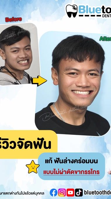 TikTok video thumbnail by bluetoothdentclinic