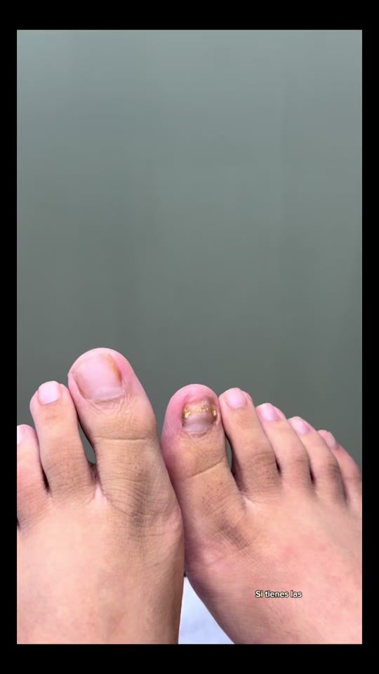 TikTok video thumbnail by pranaclinic0