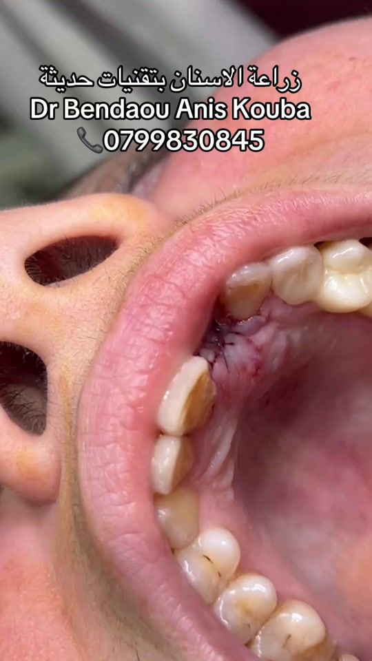 TikTok video thumbnail by dr.ben_anis