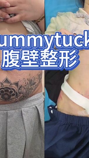 TikTok video thumbnail by leouplasticsurgery