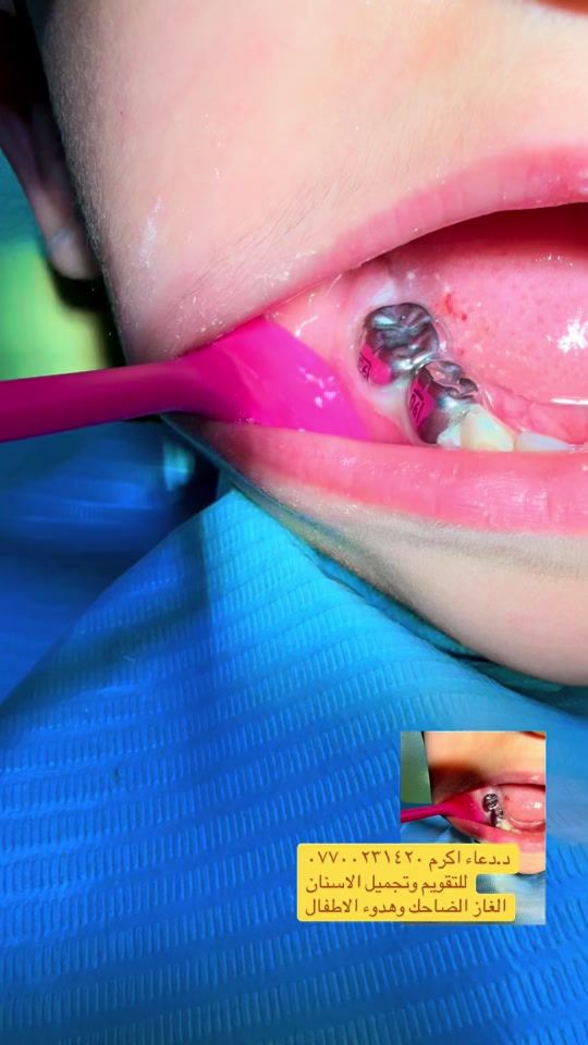 TikTok video thumbnail by drdoaaalqaisy