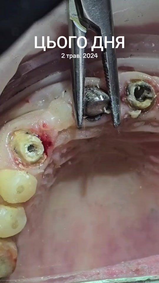 TikTok video thumbnail by dr.vadim.meloian