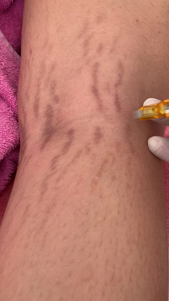 TikTok video thumbnail by elasticity_therapy_
