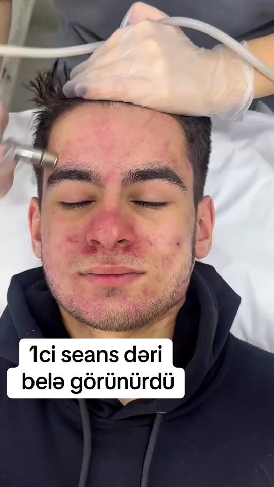 TikTok video thumbnail by dermatoloq_feride