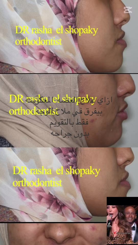 TikTok video thumbnail by dr.rasha_shopaky
