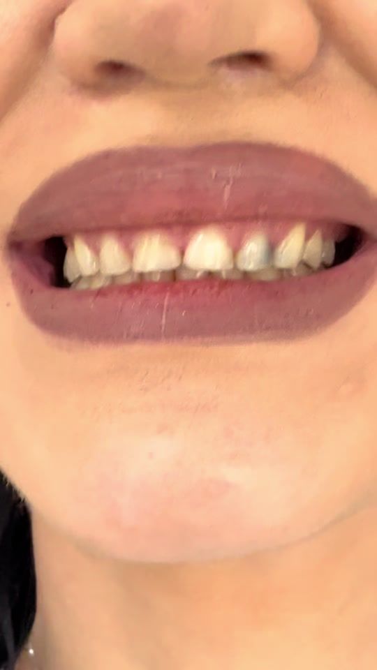 TikTok video thumbnail by keoldent
