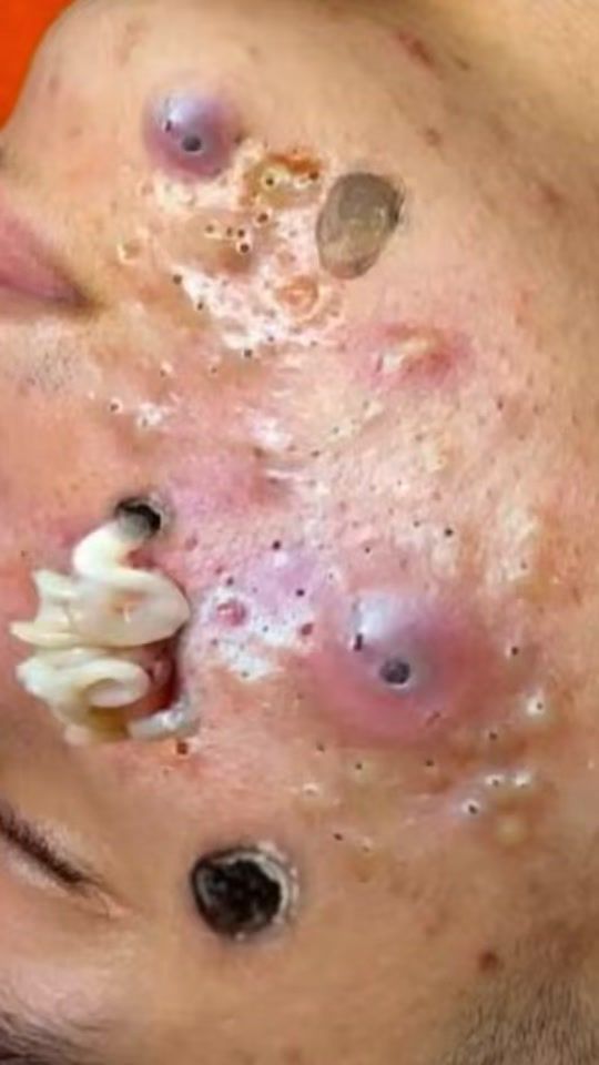 TikTok video thumbnail by blackheadremoval11