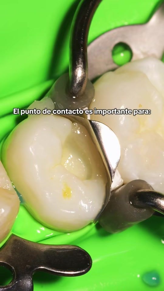 TikTok video thumbnail by perfect_dentika