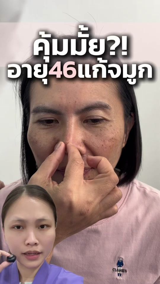 TikTok video thumbnail by lelux_surgery