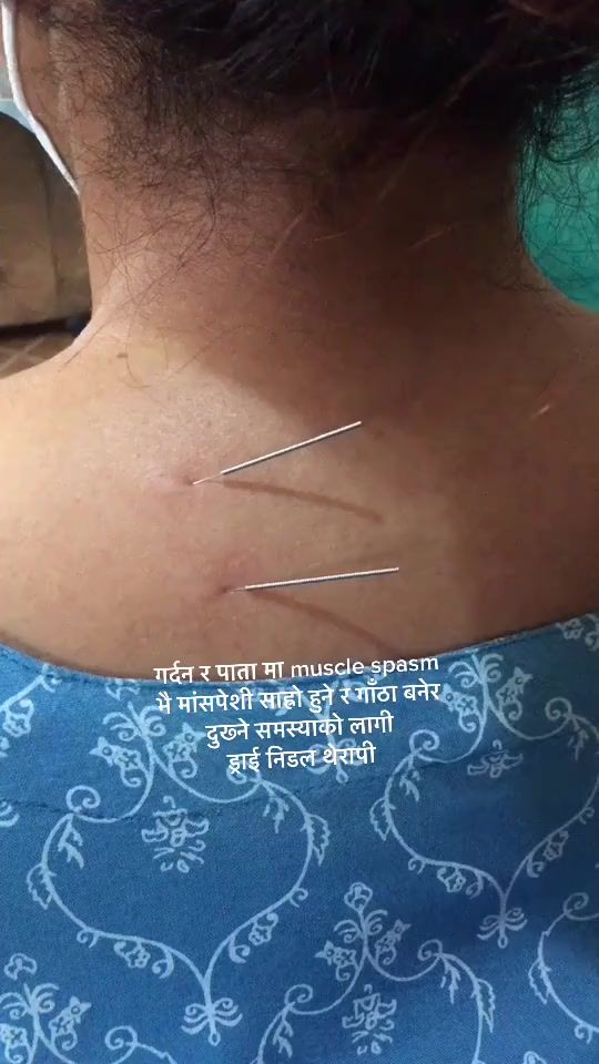 TikTok video thumbnail by cuppingmanualtherapycmt