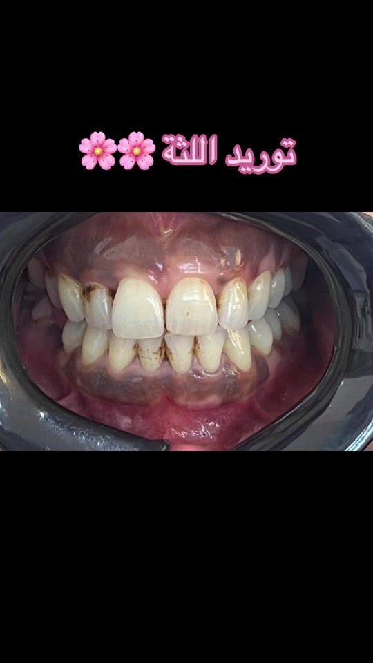 TikTok video thumbnail by dr.eya.clinic