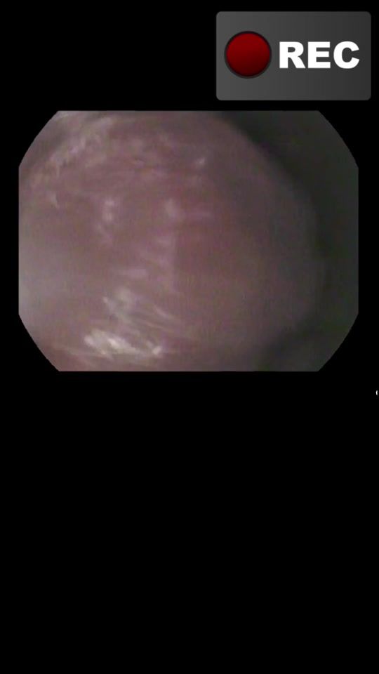 TikTok video thumbnail by almaty_endoscopy
