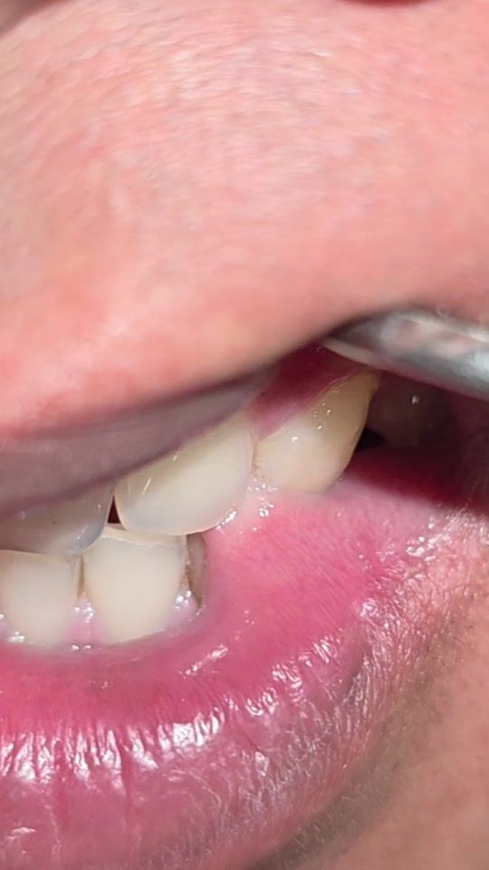 TikTok video thumbnail by nepalidentist
