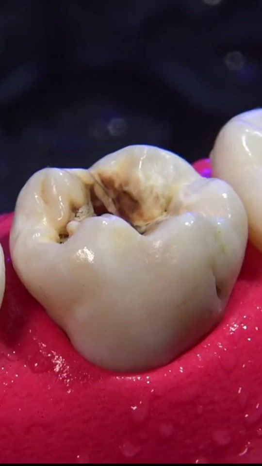 TikTok video thumbnail by perfect_dentika