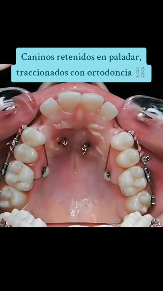 TikTok video thumbnail by odonto_y_mas