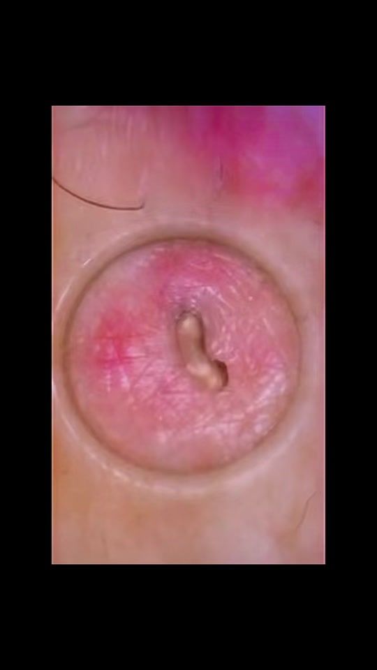 TikTok video thumbnail by blackheadremoval11