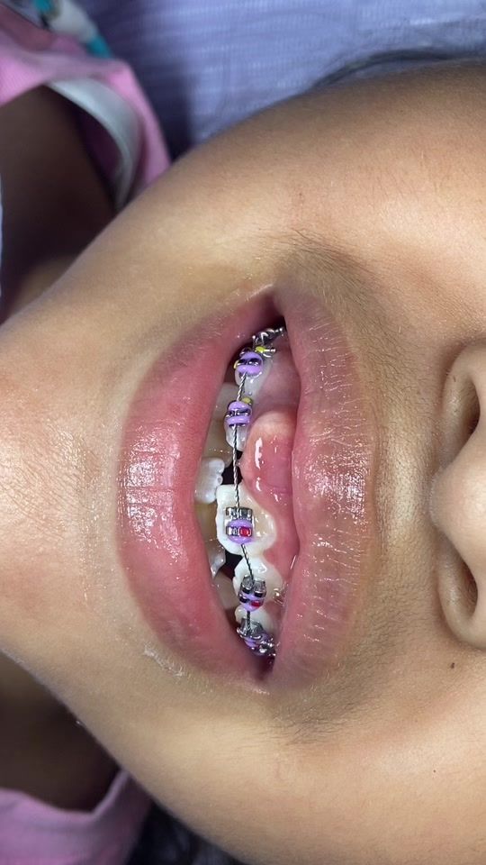 TikTok video thumbnail by maodental