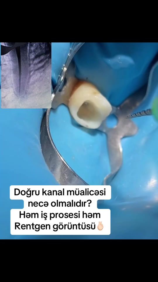 TikTok video thumbnail by dr.elvinhuseynov