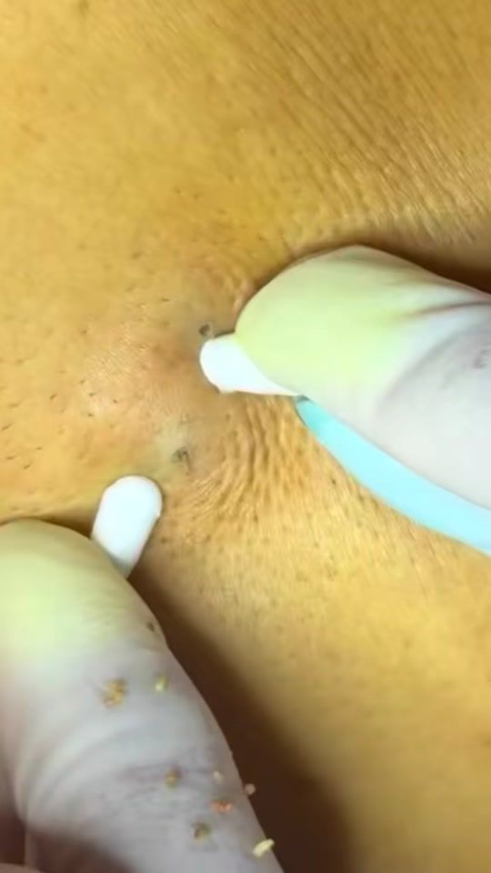 TikTok video thumbnail by blackheadremoval11