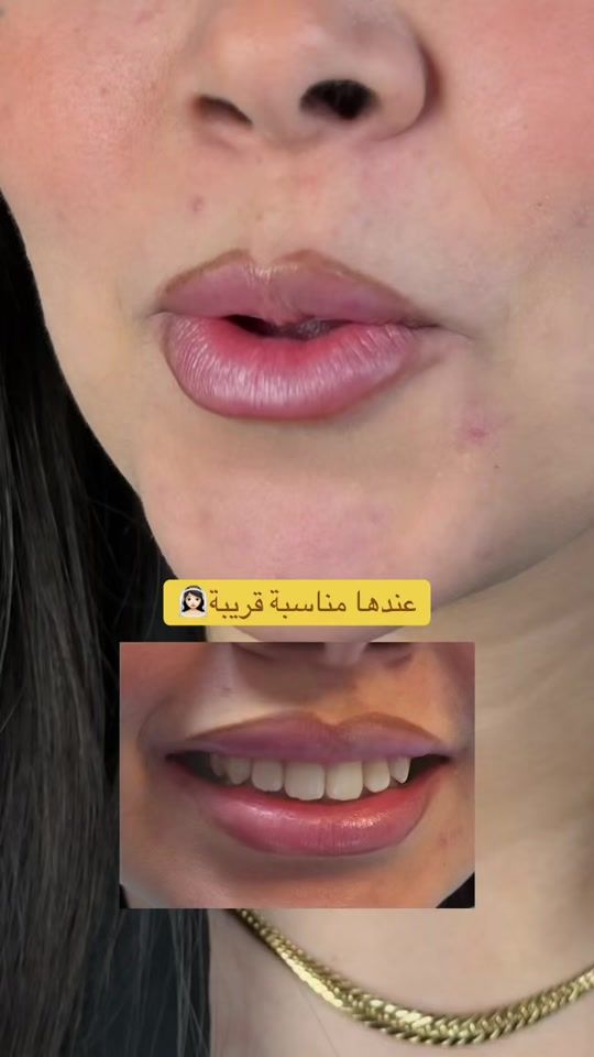 TikTok video thumbnail by albaclinics