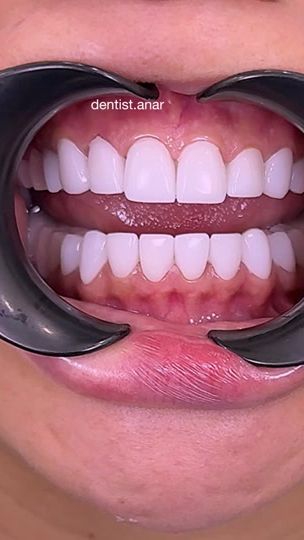 TikTok video thumbnail by dentist.anar