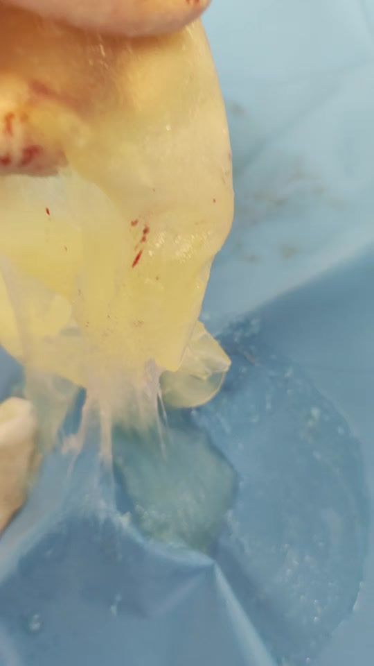 TikTok video thumbnail by dr.larbi_kamel