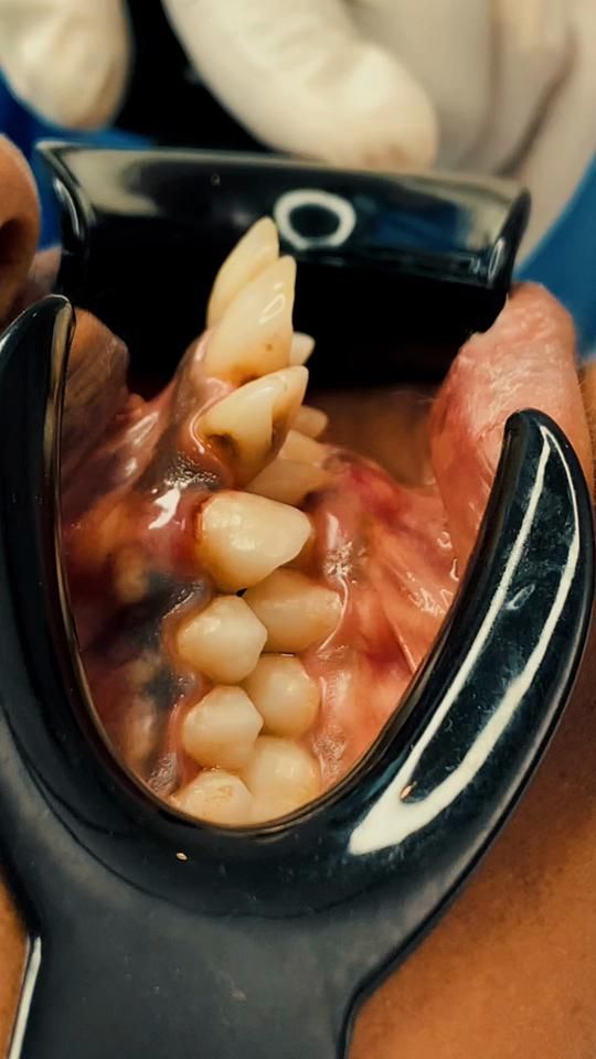 TikTok video thumbnail by dr.helina_dental