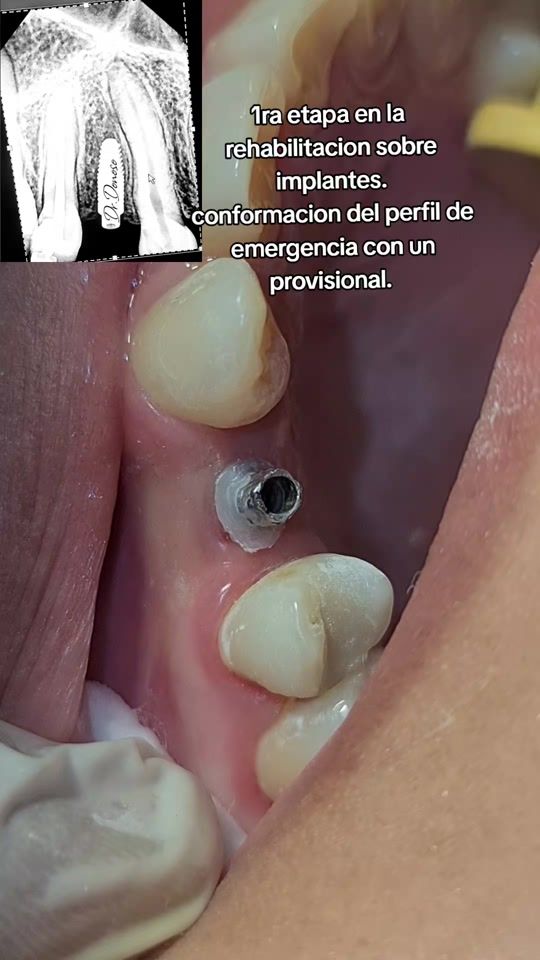 TikTok video thumbnail by dr.donoso