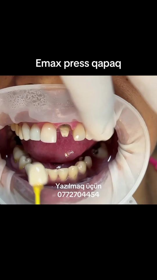 TikTok video thumbnail by dr_talehhasanzade